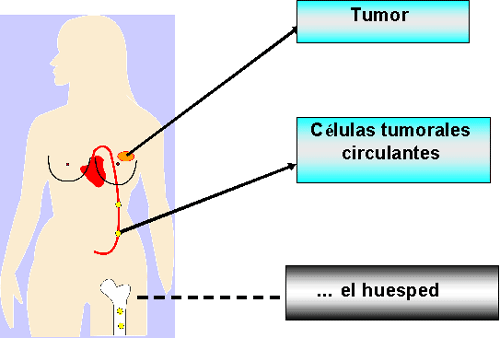 cáncer: conceptos básicos imagen de un cuerpo humano y células cancerosas en diseminación