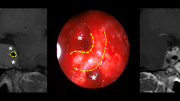 Imagen de pruebas de diagnóstico en casos de tumor hipofisiario