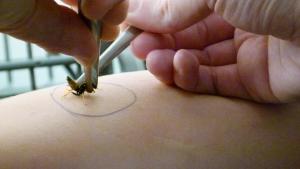 Repicadura avispa en hospital