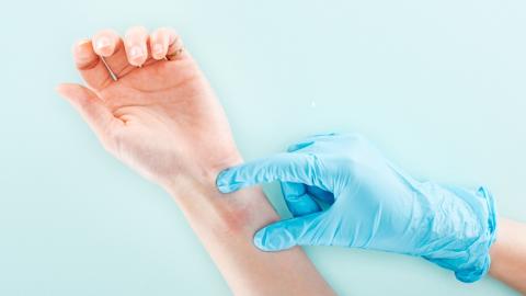 8 de julio. Día Mundial de la Alergia brazo con alergia
