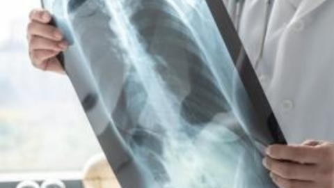 médico sosteniendo una radiografía de pulmón