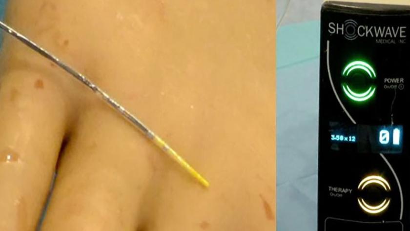 Litoplastia coronaria Fig 1