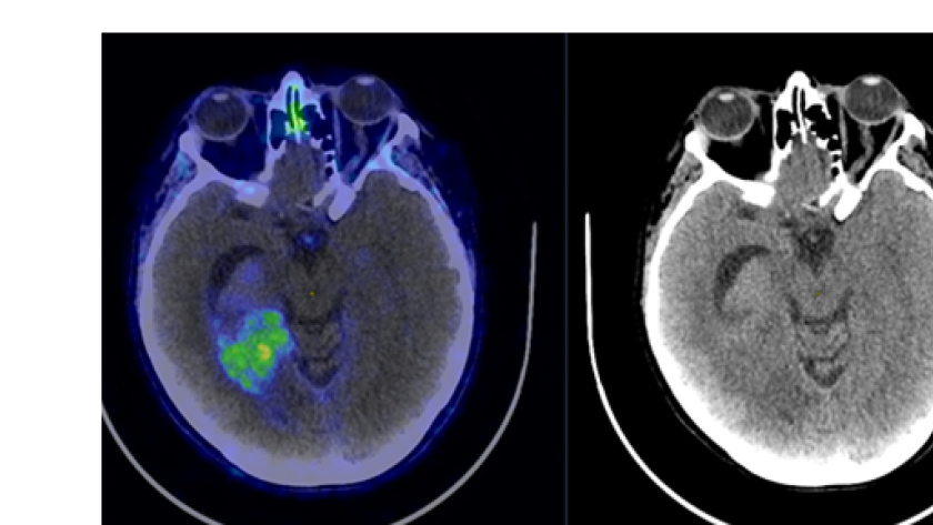 Cerebro con glioblastoma imagen de cerebro con mancha verde