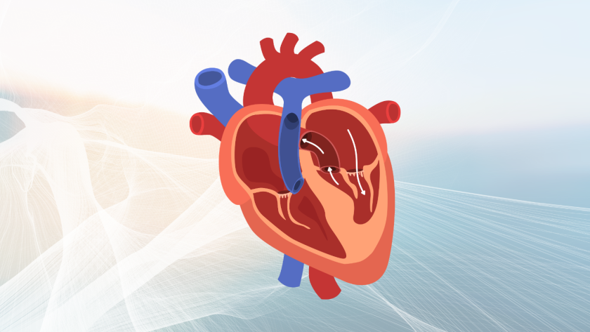 miocardiopatía hipertrófica