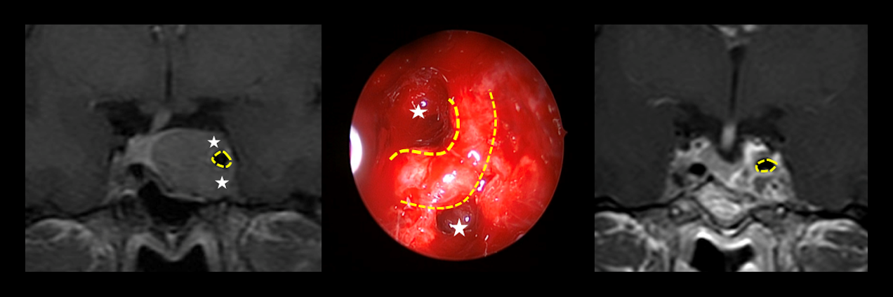 Imagen de pruebas de diagnóstico en casos de tumor hipofisiario