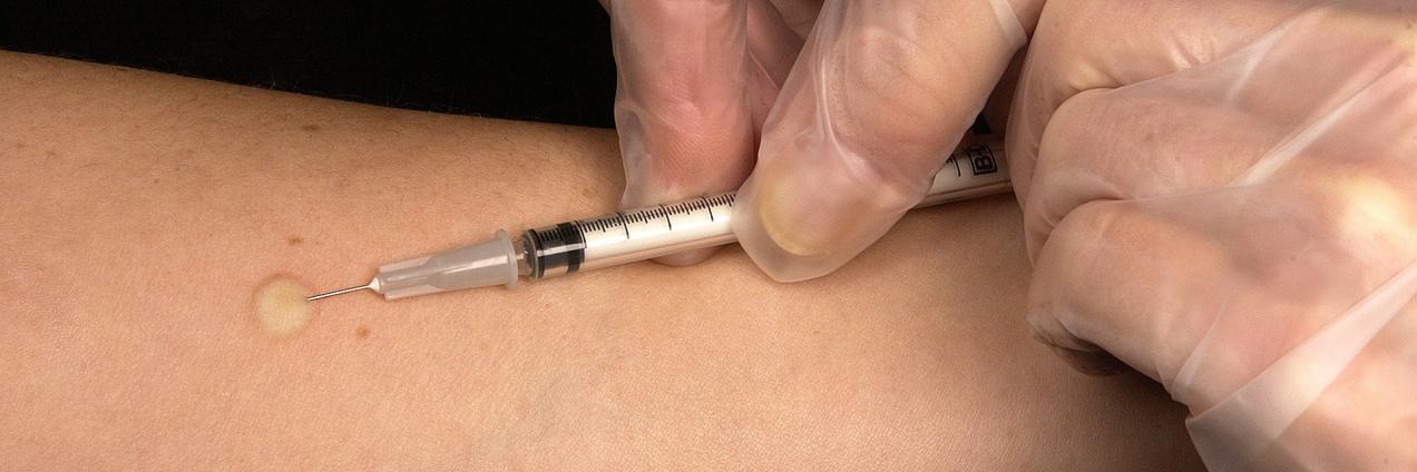 Imagen de la realización de la prueba de la tuberculina