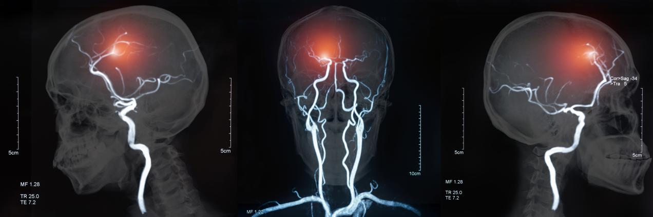 Ictus cerebral