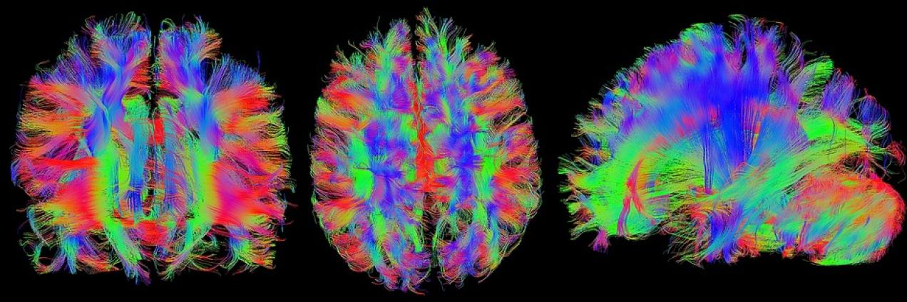 Imagen resonancia cerebro