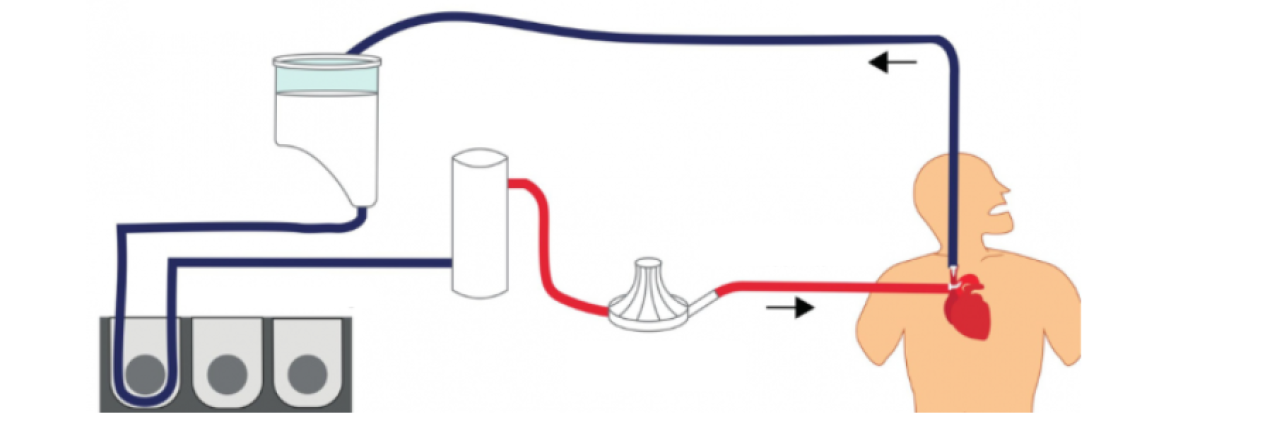 Gráfico de la técnica de circulación extracorpórea
