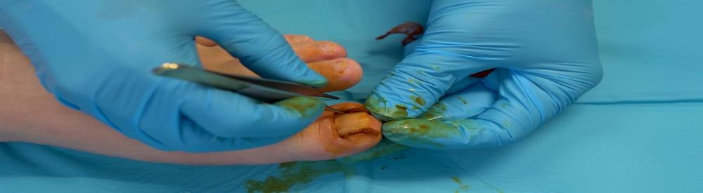 Tratamiento quirúrgico uña encarnada