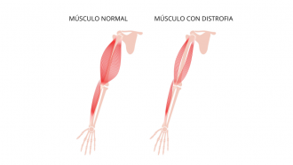 ilustración del músculo sano de un brazo y del músculo atrofiado de un brazo