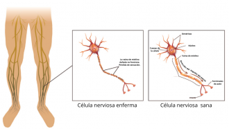 ilustración de los nervios de las piernas y de una célula sana y de una célula dañada