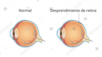 Desprendimiento de retina (prueba)