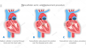 ilustración de tres corazones abiertos donde se ve la implantación de un dispositivo en la aorta