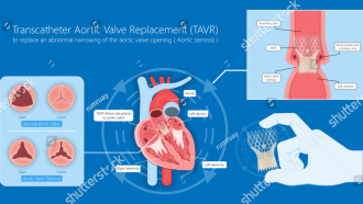 Gra´fico con imágenes de las válvulas del corazón y de la implantación en un corazón de un dispositivo con forma de cesta