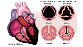 ilustración del corazón y de las válvulas sanas y enfermas, abiertas y cerradas