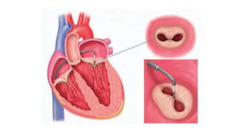 corazón abierto y al lado dos imágenes de una válvula cerrándose mediante un clip