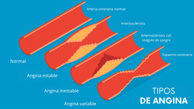 trozos de arteria que representan distintos tipos de angina con depósitos amarillos o estrechamientos