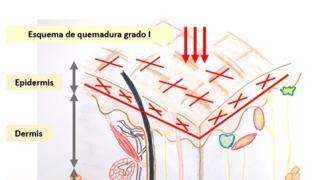 imagen articulo Como tratar quemaduras I