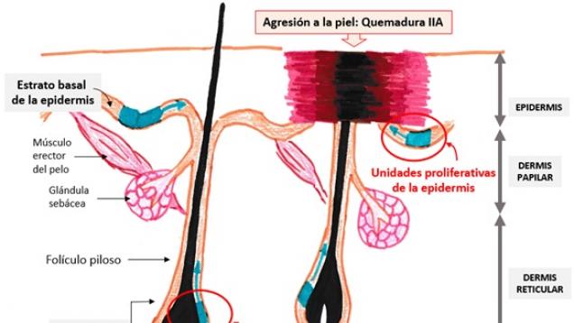 Agresión a la piel en quemadura IIA