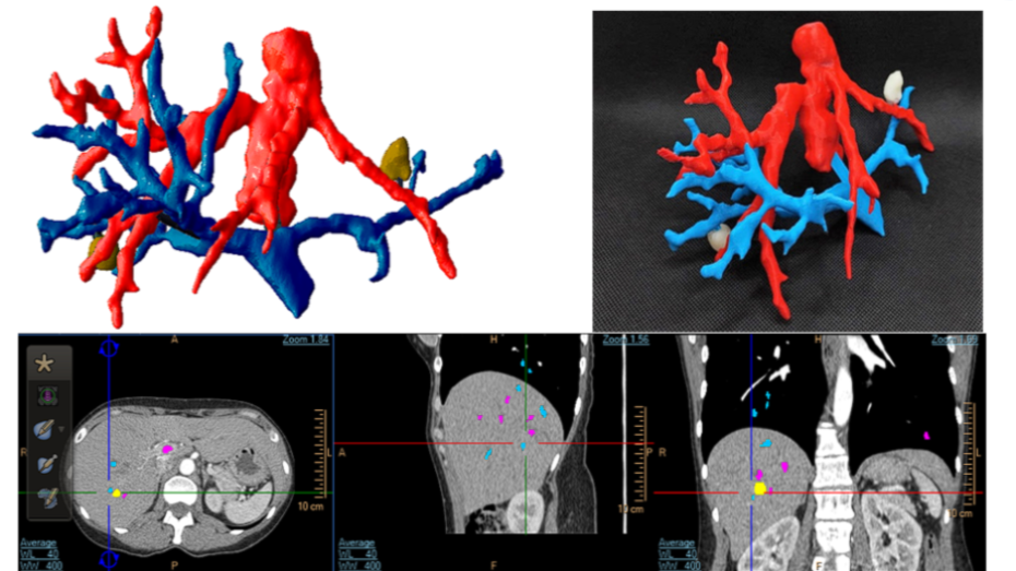 Modelo virtual, biomodelo impreso en 3D y segmentación