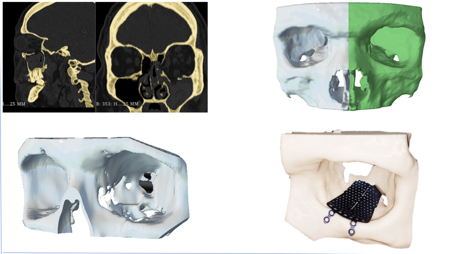 Segmentación TAC, modelo virtual órbitas, imagen especular órbita sana y biomodelo 3D con malla de titanio premoldeada