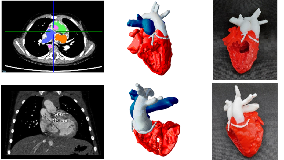 Segmentación imagen radiológica, biomodelo 3D virtual