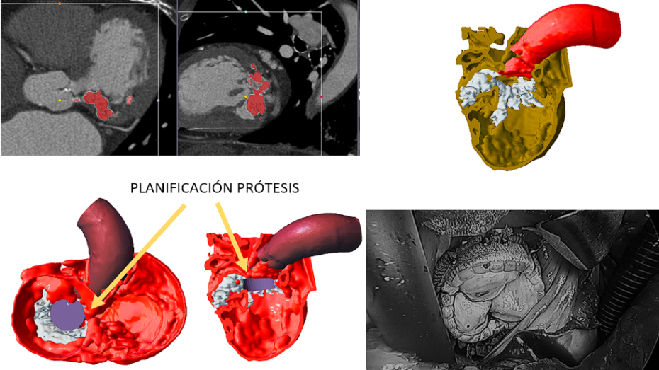 Segmentación, lanificación quirúrgica, imagen cirugía