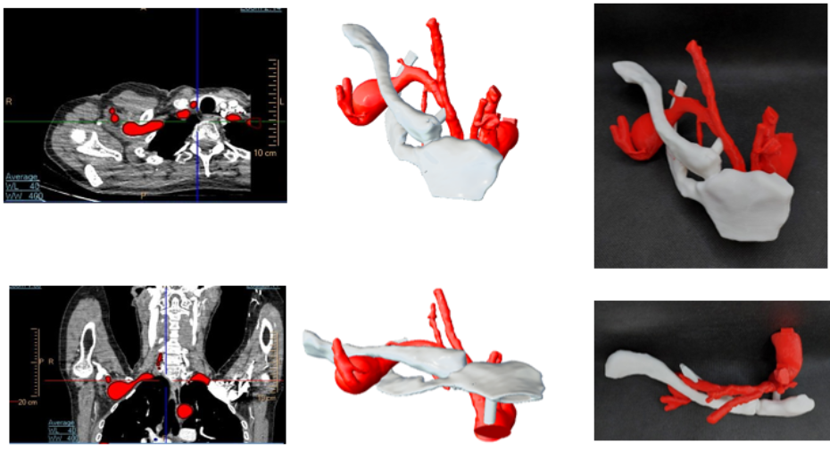 Segmentación, modelo virtual 3D, biomodelo impreso en 3D