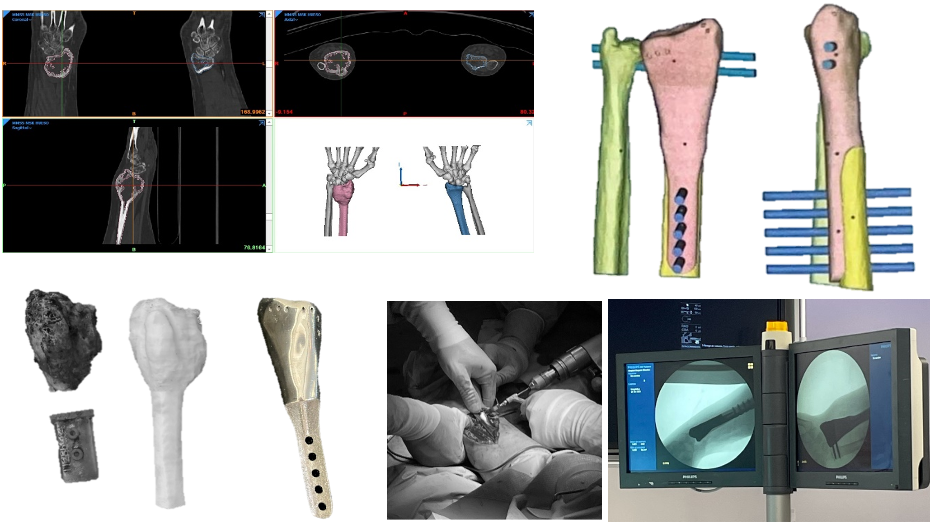 Imagen radiológica prequirúrgica segmentada, modelo virtual 3D, imagen quirúrgica, implante impreso, imagen quirúrgica, imagen postquirúrgica