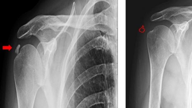 Calcificación hombro