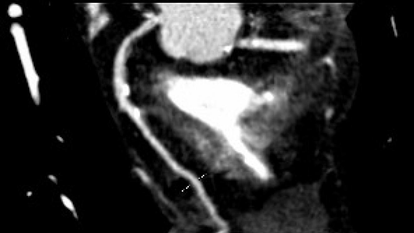 Angio tomogragía de arterias coronarias