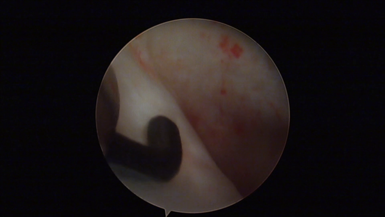 Palpación discal