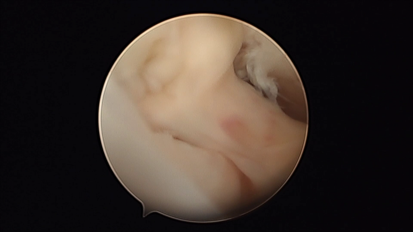 Perforación discal