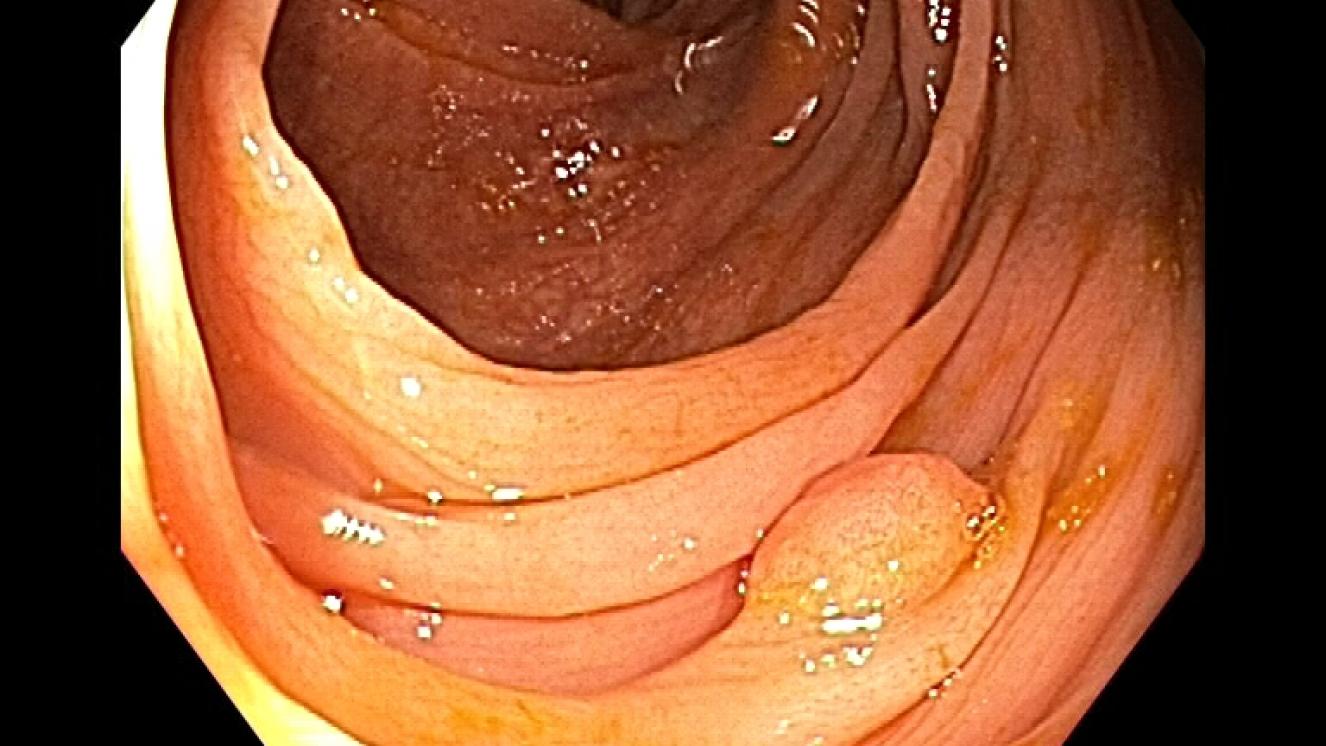 Adenoma tubular (pólipo en el colon)