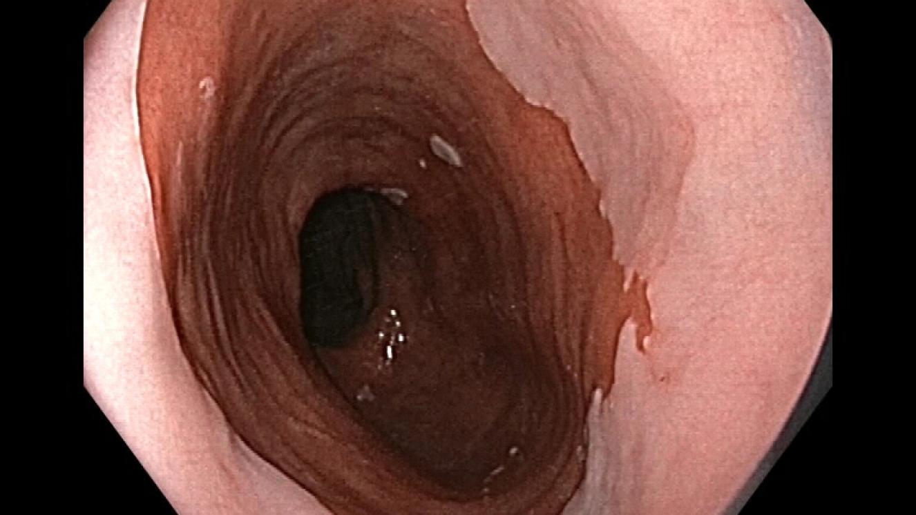 Esófago de Barrett largo (mucosa color asalmonado). Ver contraste con la mucosa pálida que presenta el esófago normal