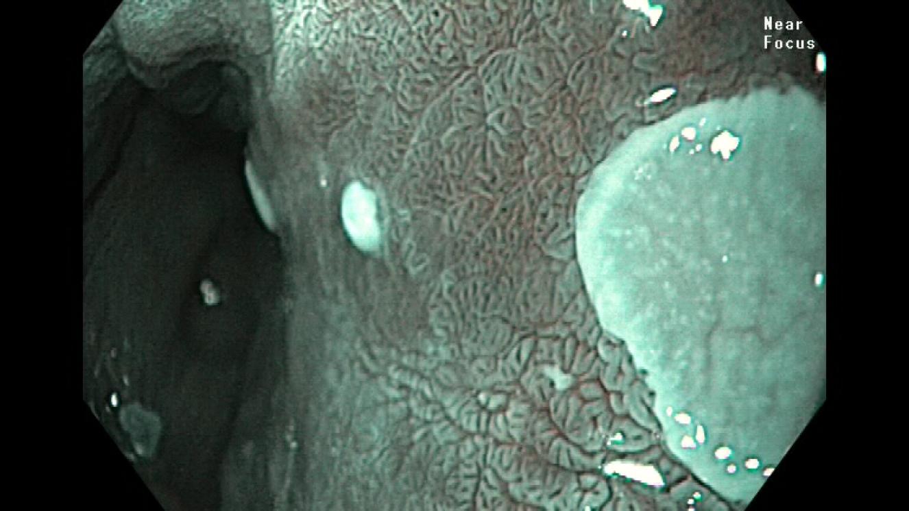 Detalle del patrón superficial del esófago de Barrett tras cromoendoscopia virtual y zoom