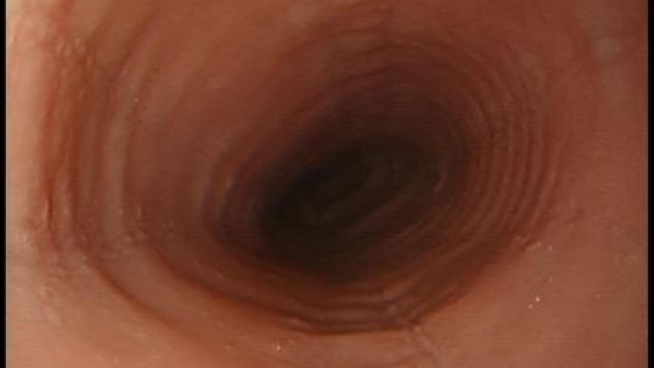 Imagen típica de esofagitis eosinofílica durante la realización de una panendoscopia oral