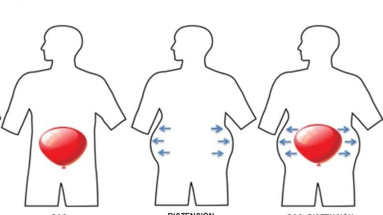 Diagrama explicativo de la distensión abdominal