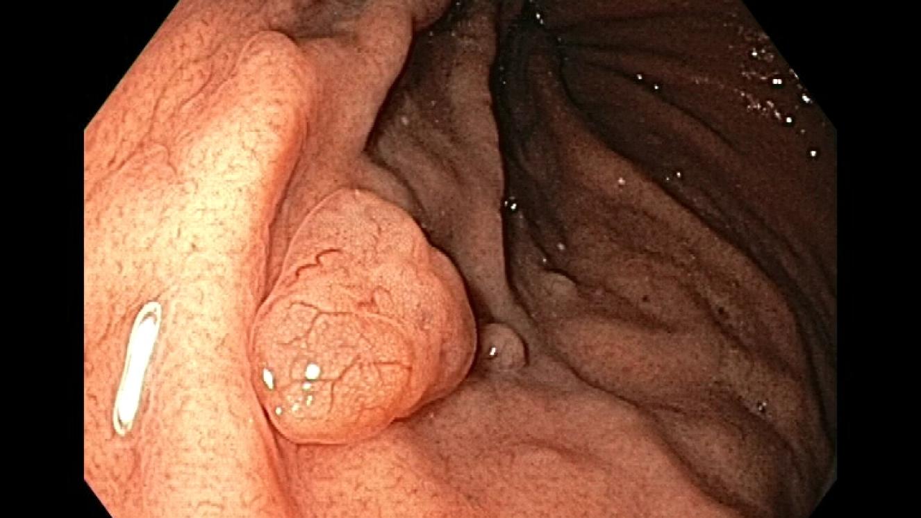 pólipo de glándulas fúndicas (pólipo en el estómago)