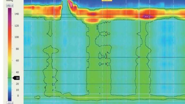 Perfil de acalasia visto por manometría esofágica