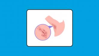Ilustración médica que muestra lesiones y cicatrices en la axila, con un detalle ampliado en un círculo, representativa de la hidradenitis supurativa.