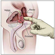 imagen que muestra la práctica de un tacto rectal