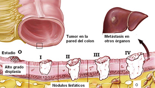 cancer de colon nivel 2