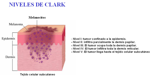 Niveles de Clark. Extensión cáncer de piel