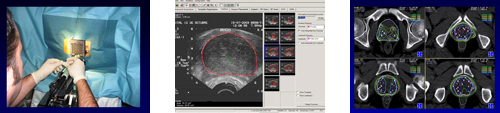 Radioterapia en cáncer de próstata. 