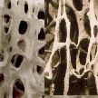 OSTEOPOROSIS