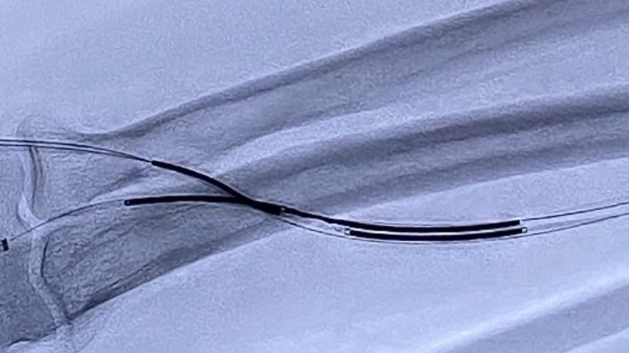 Fistula endovascular