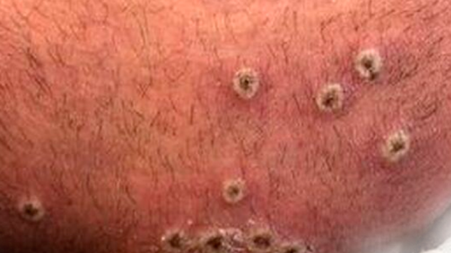 foto de lesiones de un paciente con viruela de mono