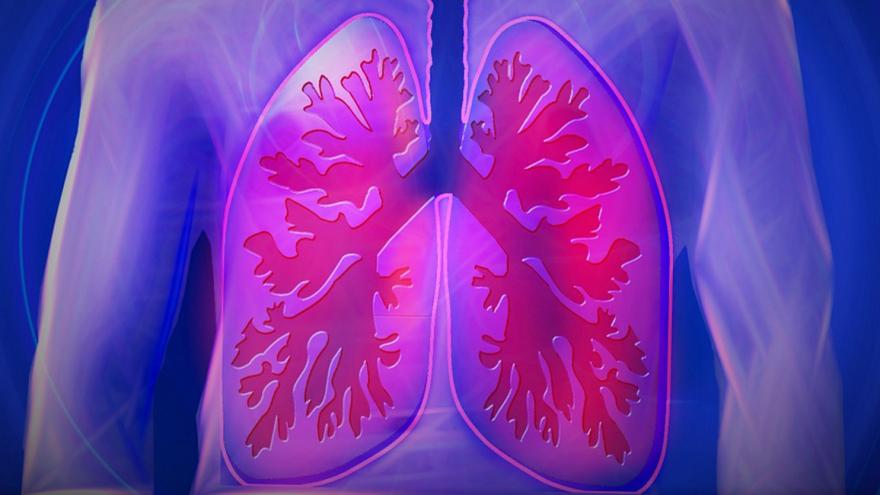Enfermedad Pulmonar